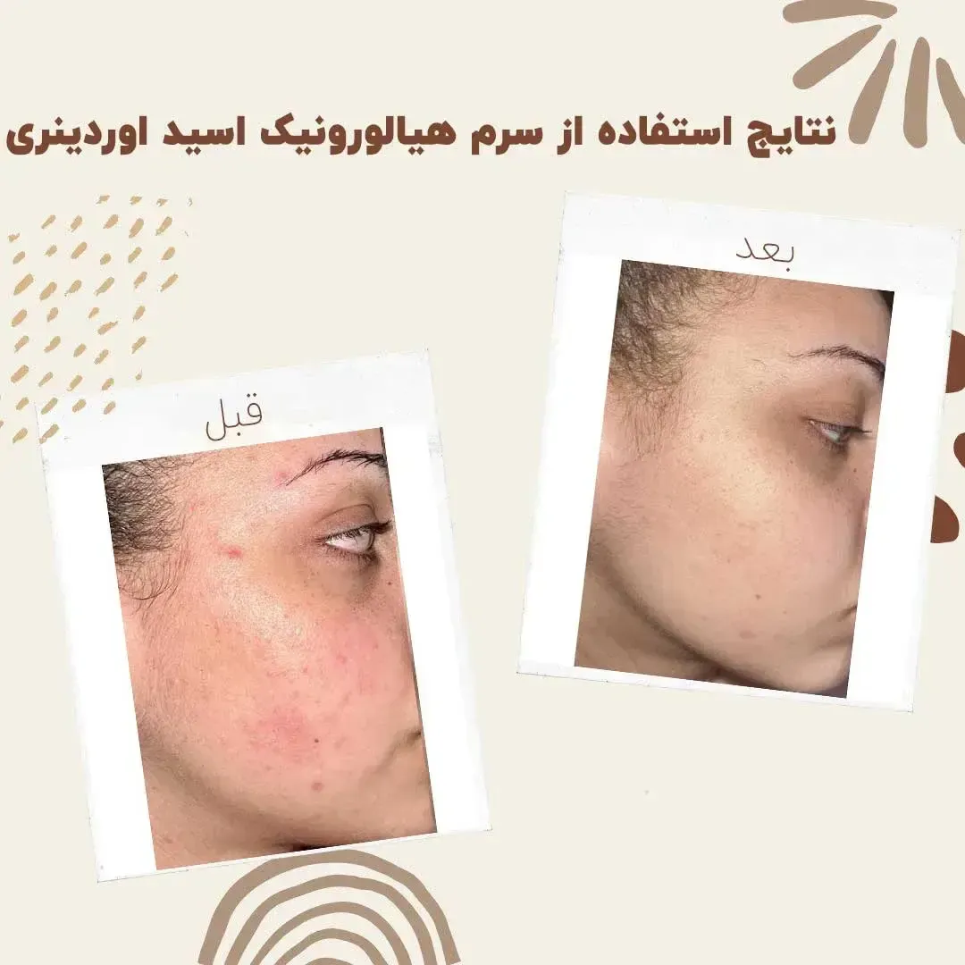 خرید هیالورونیک اسید چینی برای تولیدکنندگان ماسک، سرم و محصولات مراقبت از مو